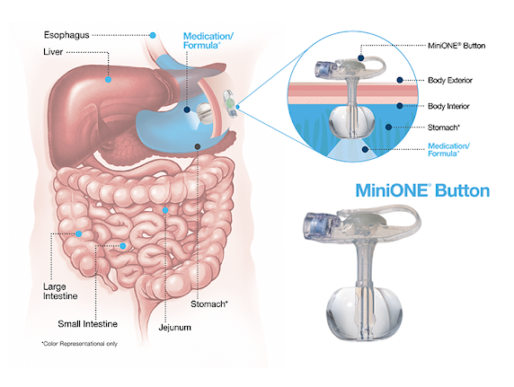 MiniONE® Balloon  Applied Medical Technology