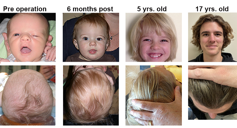 Images of coronal craniosynostosis before and after treatment